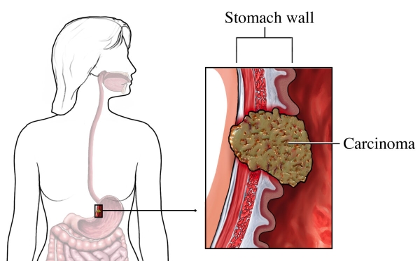 Stomach Cancer Symptoms And Causes City Of Hope California